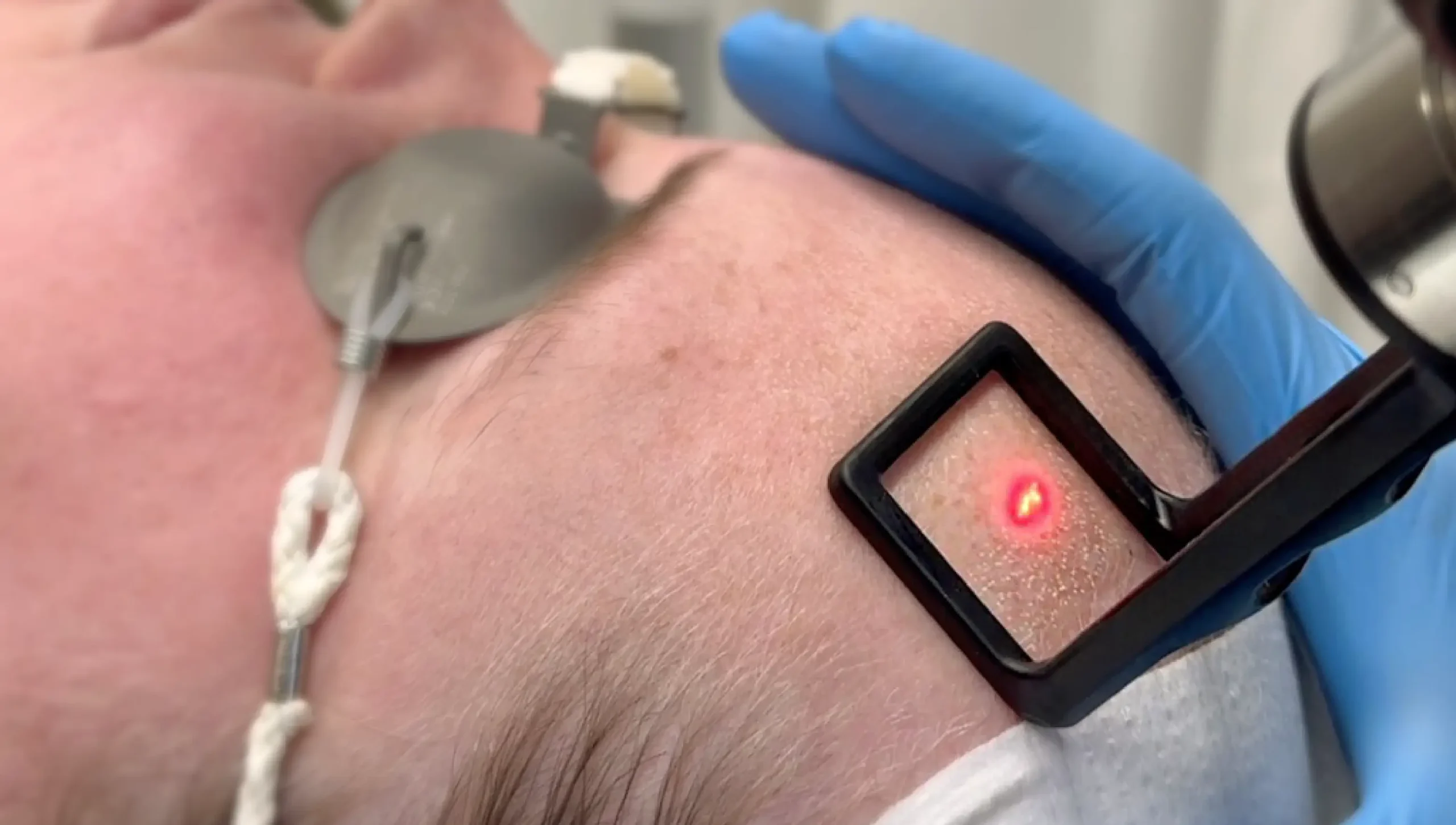 Coolpeel Treatment