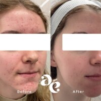Acne scarring treatment comparison