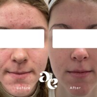 Acne scarring treatment comparison