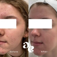 Acne scarring treatment comparison