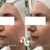 Acne scarring treatment comparison