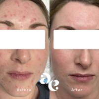 Acne scarring treatment comparison
