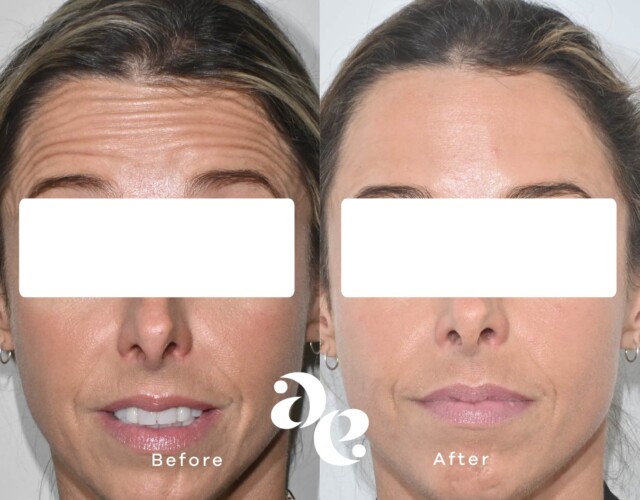 Anti-Wrinkle Forehead Treatment Antiwrinkle treatment