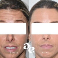 Antiwrinkle treatment