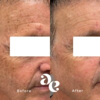 #image_title Pigment treatment comparison