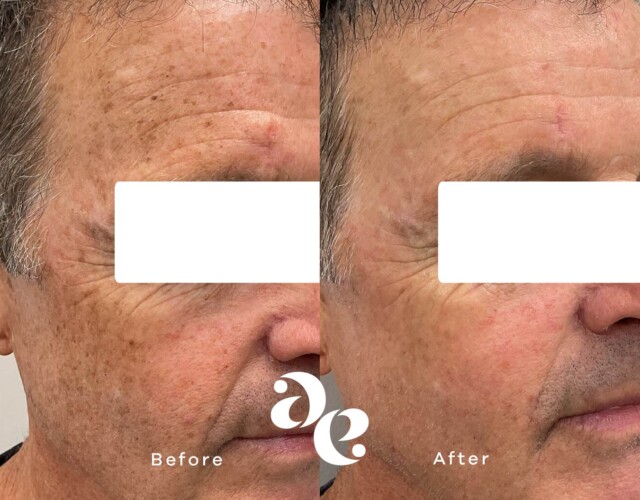 Hyper Pigmentation Treatment Pigment treatment comparison