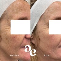 #image_title Pigment treatment comparison