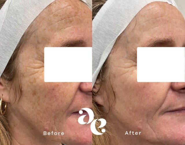 #image_title Pigment treatment comparison