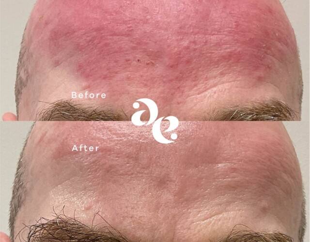 Redness Treatment Rosacea treatment comparison