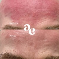 #image_title Rosacea treatment comparison