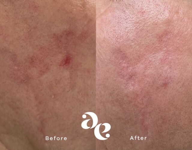 Redness Treatment Scar treatment comparison