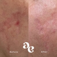 Scar treatment comparison