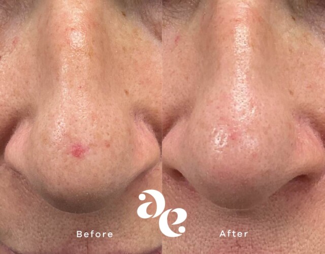 Nd:YAG Laser Treatment Vascular treatment comparison