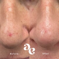 #image_title Vascular treatment comparison