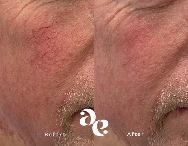 IPL for Redness Vascular treatment comparison