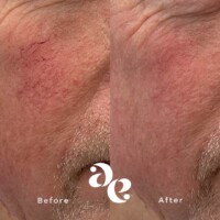 #image_title Vascular treatment comparison