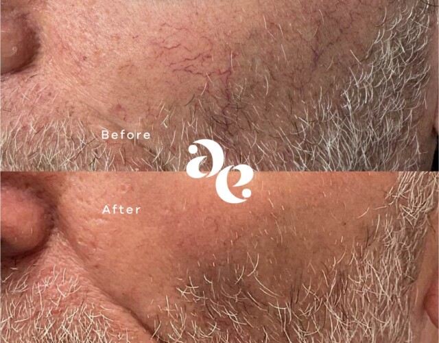 IPL for Redness Vascular treatment comparison
