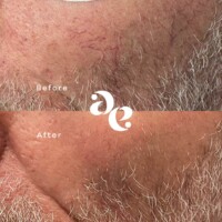 #image_title Vascular treatment comparison