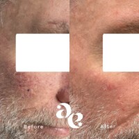 #image_title Vascular treatment comparison