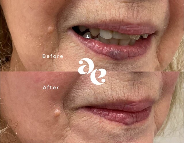 Nd:YAG Laser Treatment Vascular treatment comparison
