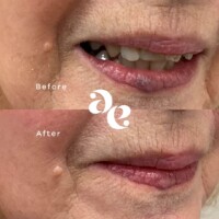 #image_title Vascular treatment comparison