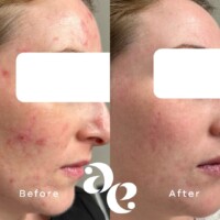 Acne treatment comparison