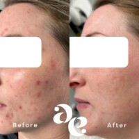Acne treatment comparison