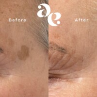 #image_title Pigment treatment comparison