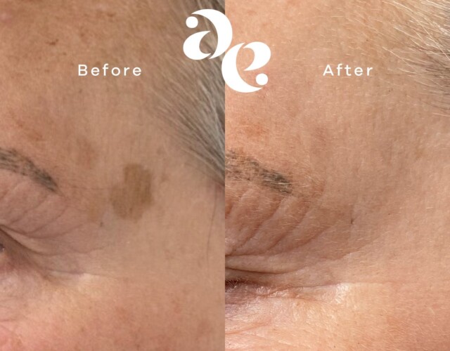 Laser for Pigmentation Pigment treatment comparison