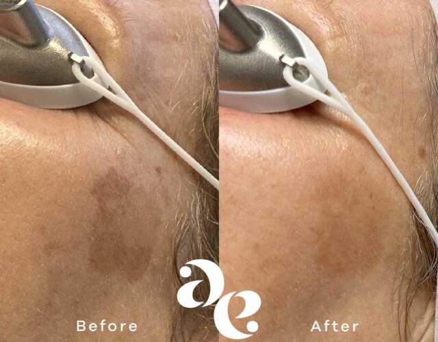 Laser for Pigmentation Pigment treatment comparison