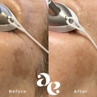 #image_title Pigment treatment comparison