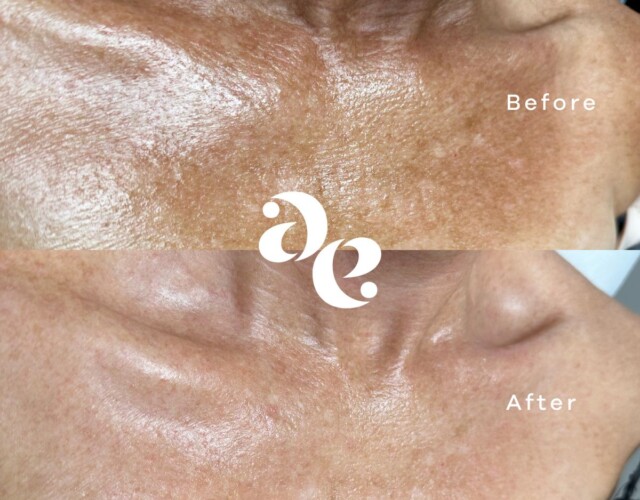 Laser for Pigmentation