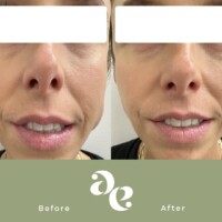 #image_title Antiwrinkle treatment