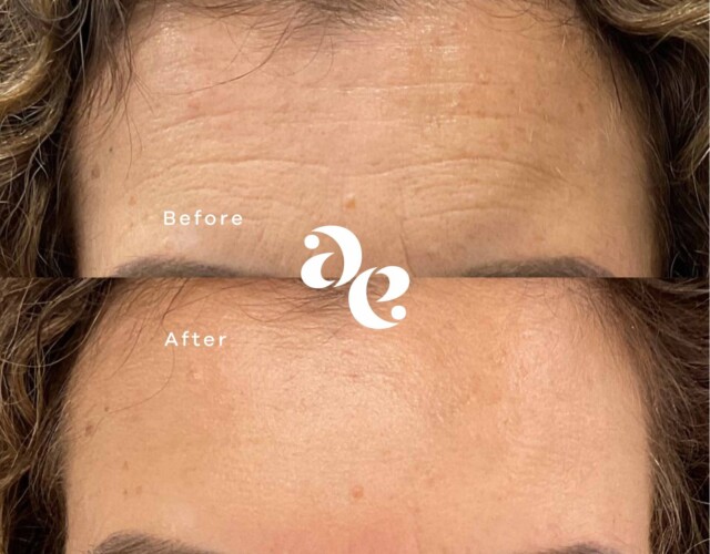Anti-Wrinkle Forehead Treatment Antiwrinkle treatment