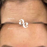Antiwrinkle treatment
