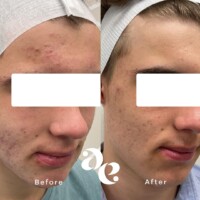 Acne treatment comparison