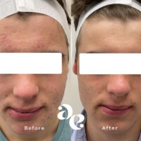 Acne treatment comparison