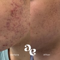 Acne treatment comparison