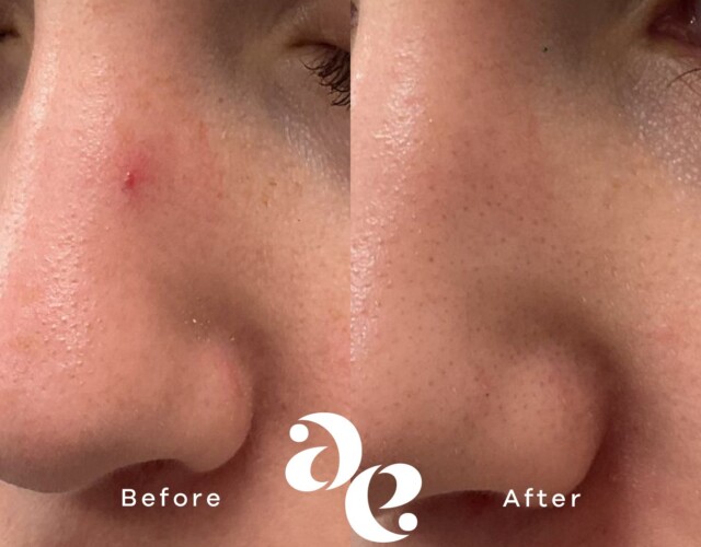 Ng:YAG Laser Treatment Vascular treatment comparison