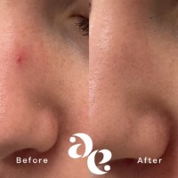 #image_title Vascular treatment comparison