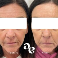 Antiwrinkle treatment