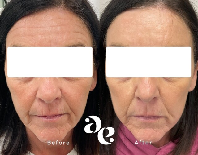 Anti-Wrinkle Forehead Treatment Antiwrinkle treatment