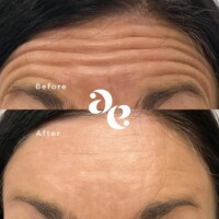 Antiwrinkle treatment