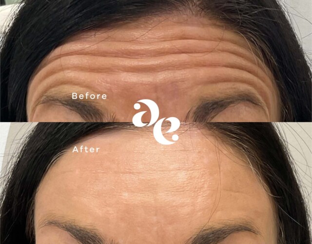 Anti-Wrinkle Forehead Treatment Antiwrinkle treatment