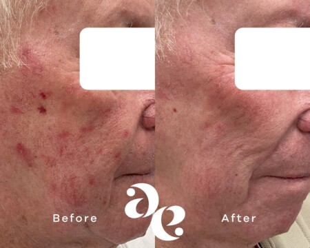 Laser for Redness Rosacea treatment comparison