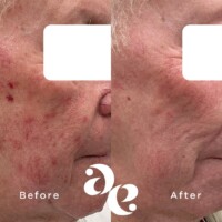 #image_title Rosacea treatment comparison