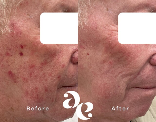 Laser for Redness Rosacea treatment comparison