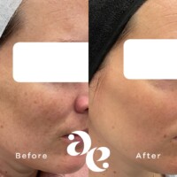 Pigment treatment comparison
