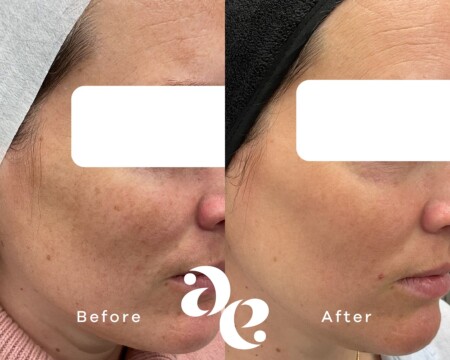 Pigment treatment comparison