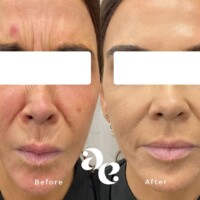 Antiwrinkle treatment